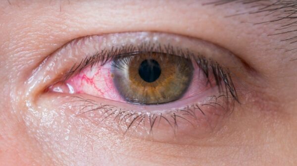 St 79 Auge BILD iStock