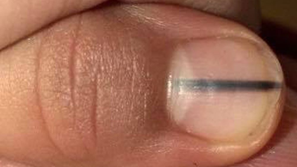 Schwarzer Streifen unterm Fingernagel - Lebensgefahr!