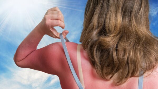Sonnenbrand